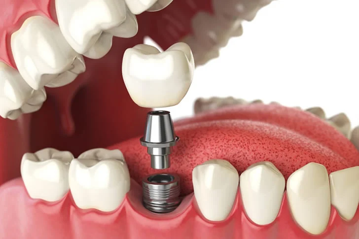 Zahnimplantate sind eine beliebte und effektive Lösung für den Ersatz fehlender Zähne, können jedoch oft eine kostspielige Angelegenheit sein. In Deutschland variieren die Kosten für Zahnimplantate je nach...